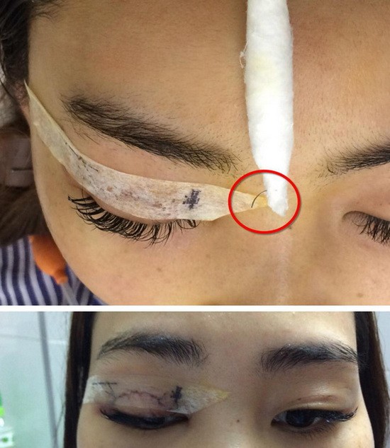 河內一名女士在某美容單位為眼部微整時，突然被1根長5毫米、直徑0.2毫米的針子(畫紅圈)刺入眼窩，隨後找不到。（圖源：醫生提供）
