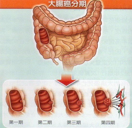 大腸癌病例五至六成發現較晚。（示意圖源：互聯網）