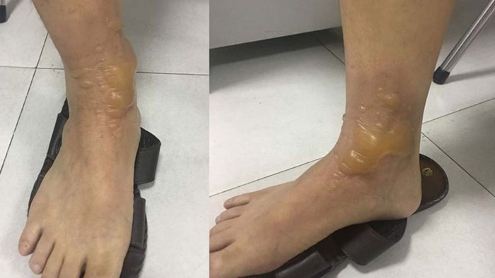 被沸水燙傷出水泡的右腳。（圖源：翠寧）