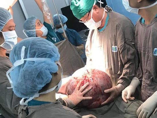 經手術取出體外的巨大卵巢腫瘤。（圖源：醫院提供）