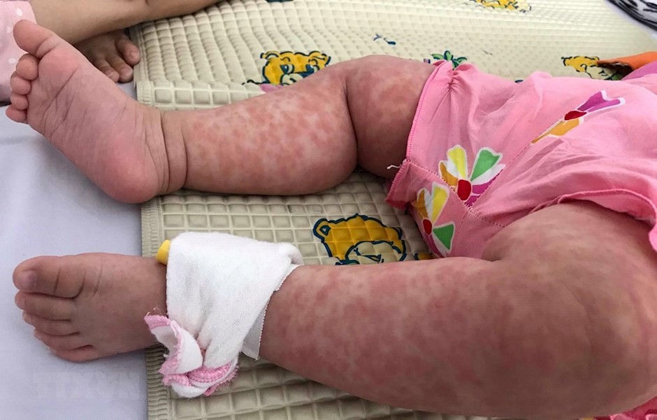 被確診的一例麻疹病例。（圖源：越通社）