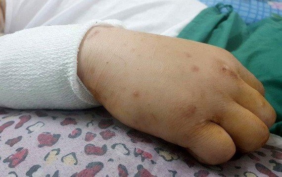 歷經多個小時的搶救手術，傷者斷臂成功接上。（圖源：Zing）