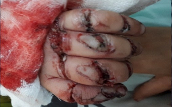 病童的手掌傷勢十分嚴重。（圖源：院方提供）