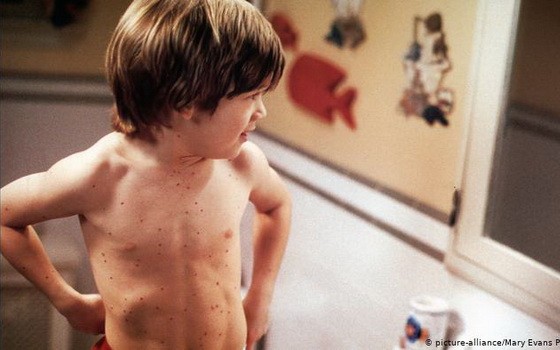 去年麻疹病例大幅上升。（圖源：互聯網）