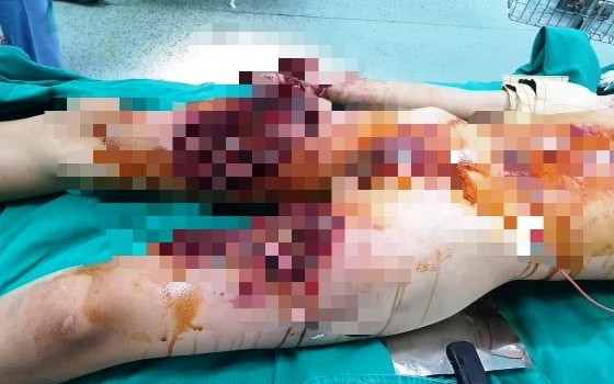 范春 L 的傷勢十分嚴重。（圖源：院方提供）