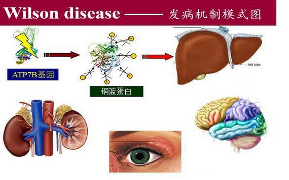 肝豆狀核變性，又稱威爾遜病。（圖源：互聯網）