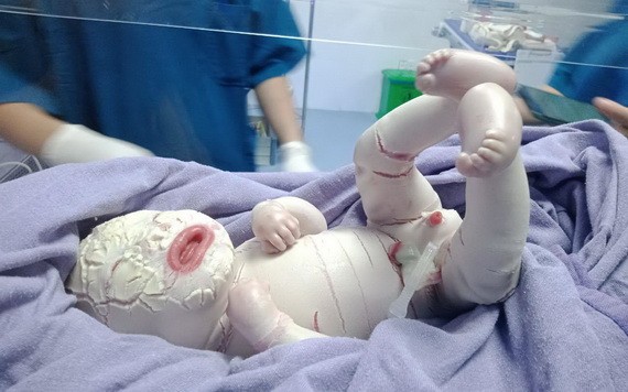 初生男嬰不幸患上全身長滿魚鱗蘚的罕見疾病。（圖源：院方提供）