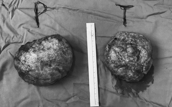 經手術取出的兩塊乳房植入物。（圖源：院方提供）