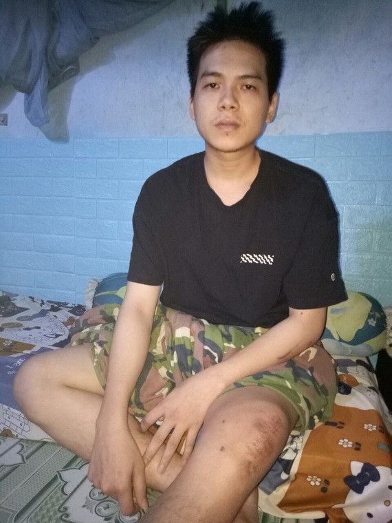 姚傳大基的左腿動手術後不良於行。