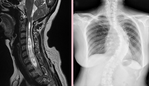 從影像學中可看出黃女士脊椎側彎角度頗大。