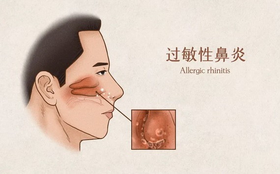 過敏性鼻炎發作期間不能使用抗生素