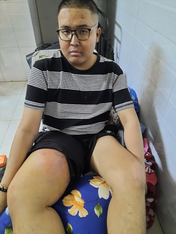 鄭家雄右腿浮腫,行動困難。