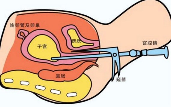 宮腔鏡術後怎樣調養