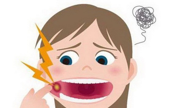 警惕這種口腔潰瘍