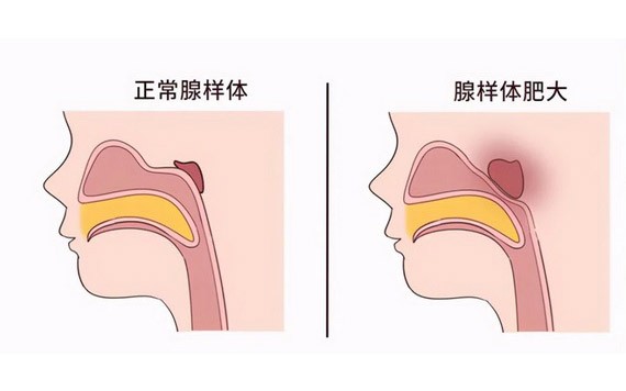 腺樣體腫大會帶來３大健康隱患