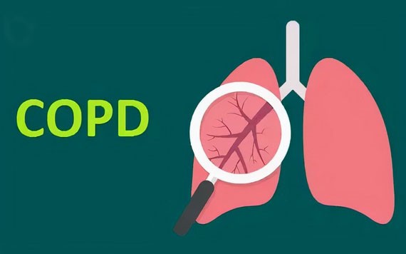 慢阻肺專盯５類人