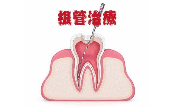 做完根管治療後須注意問題