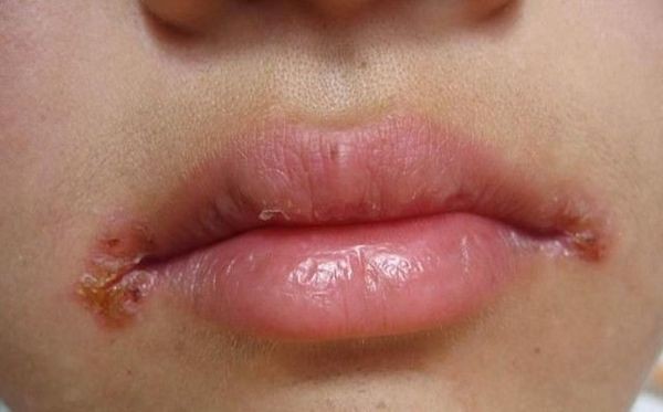 唇皰疹不是口角炎