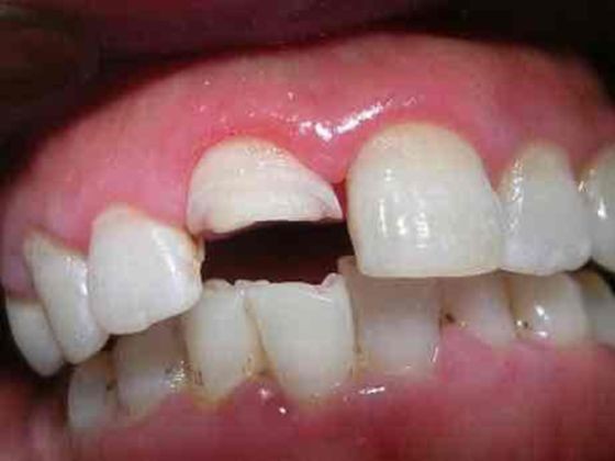 孩子门牙磕掉了一块可不管吗?