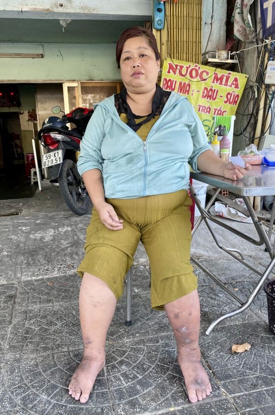 陈玉燕肿痛的双脚发黑。