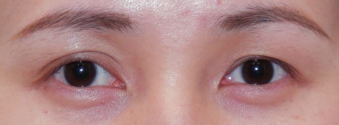 双眼皮浮肿小心甲状腺作怪