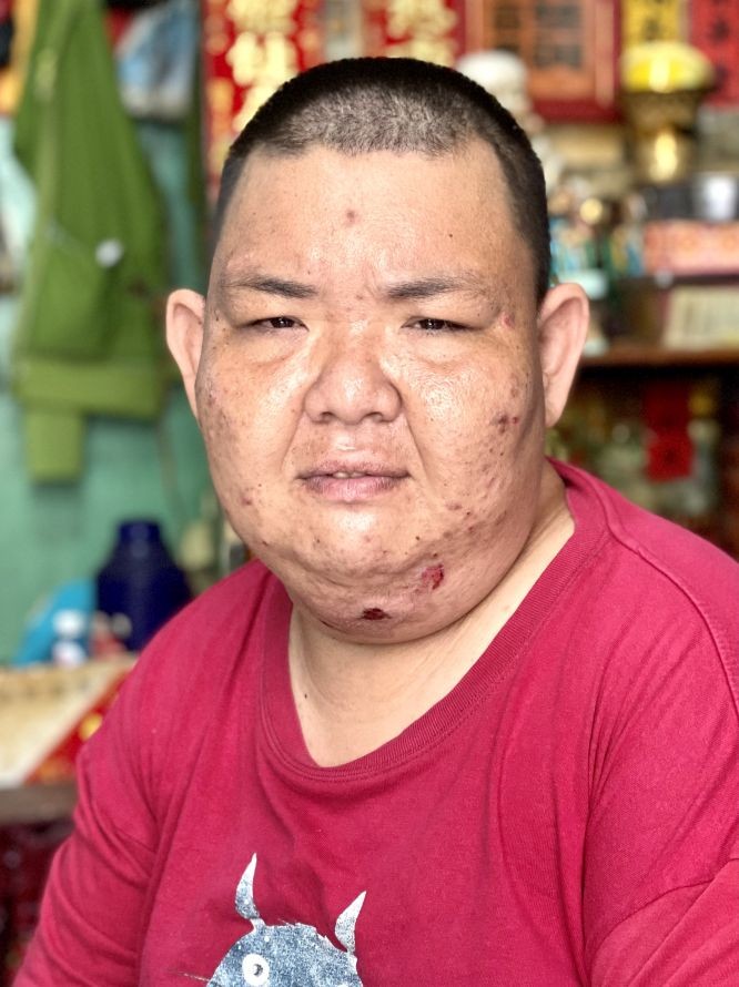 张家荣吃药后肥胖起来。 张家荣吃药后肥胖起来。