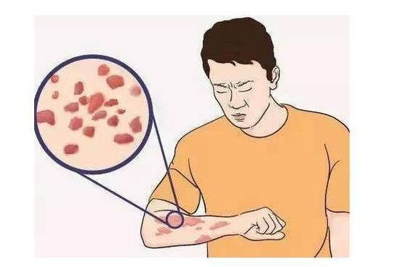 被隐翅虫、蜱虫、蜈蚣肆虐或咬怎么办?