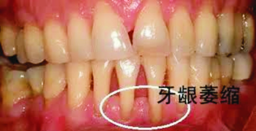 还在因牙龈萎缩烦恼?