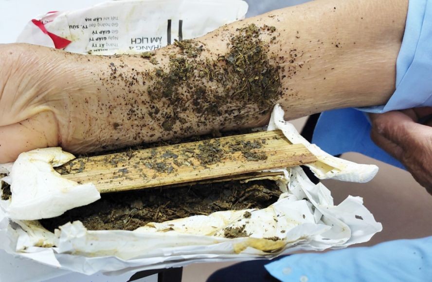 一名病人手部骨折,敷贴草药后却手臂弯曲,要住院接受治疗。 一名病人手部骨折,敷贴草药后却手臂弯曲,要住院接受治疗。