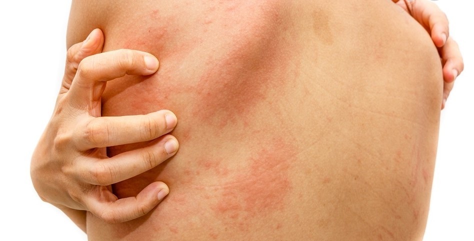 压力、运动竟会诱发荨麻疹