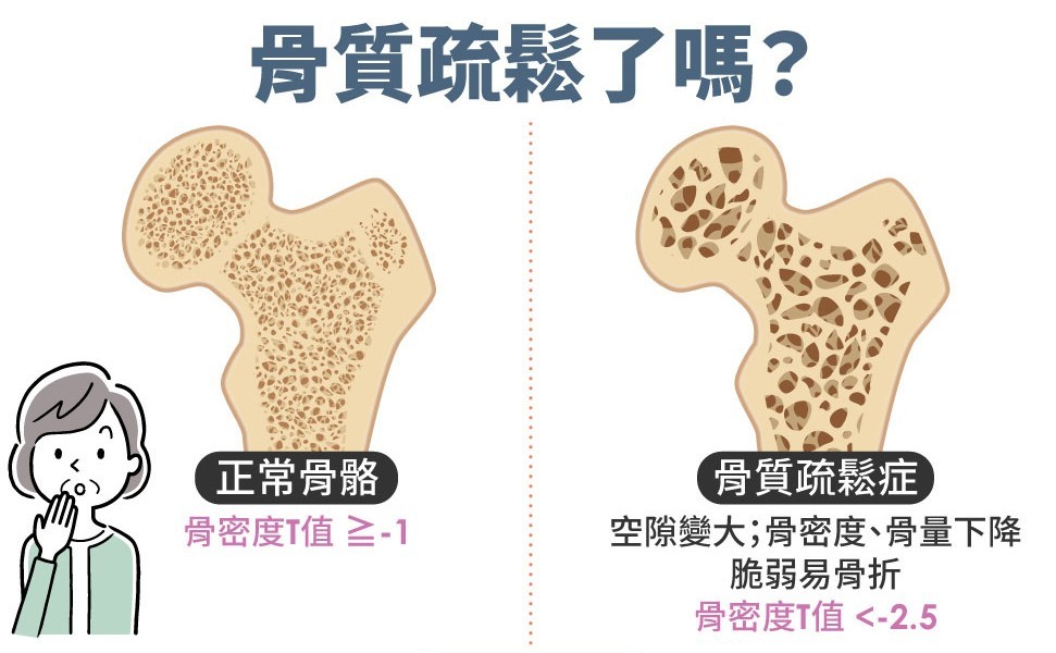 骨质疏松有什么症状？