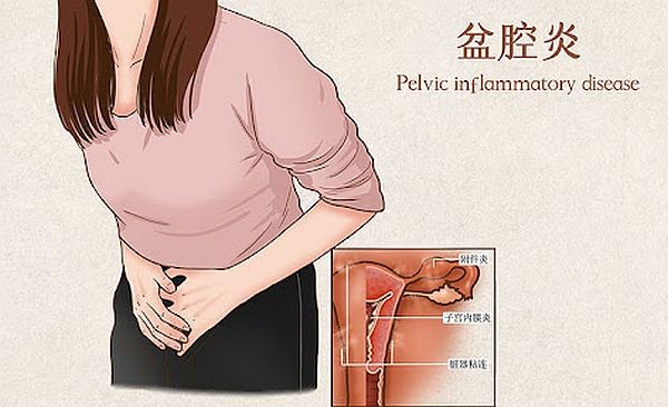 有盆腔积液就意味着有盆腔炎吗?