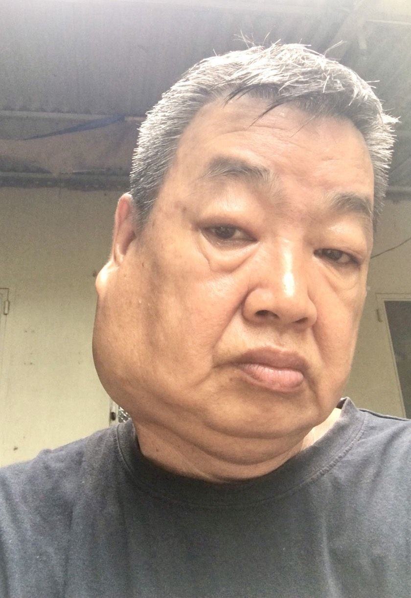 男子右腮患恶瘤