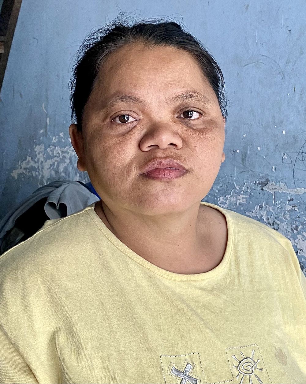 患脑瘤女子无钱医治