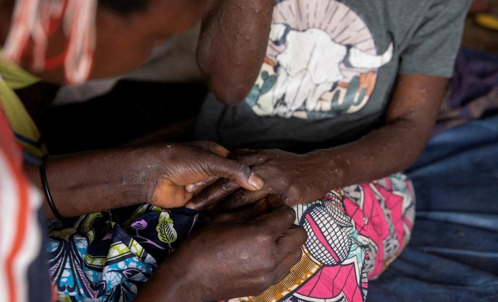 猴痘的初期症状包括发烧、头痛、肌肉酸痛、背痛、淋巴结肿大，之后可发展为面部和身体大范围皮疹。（图：路透社）