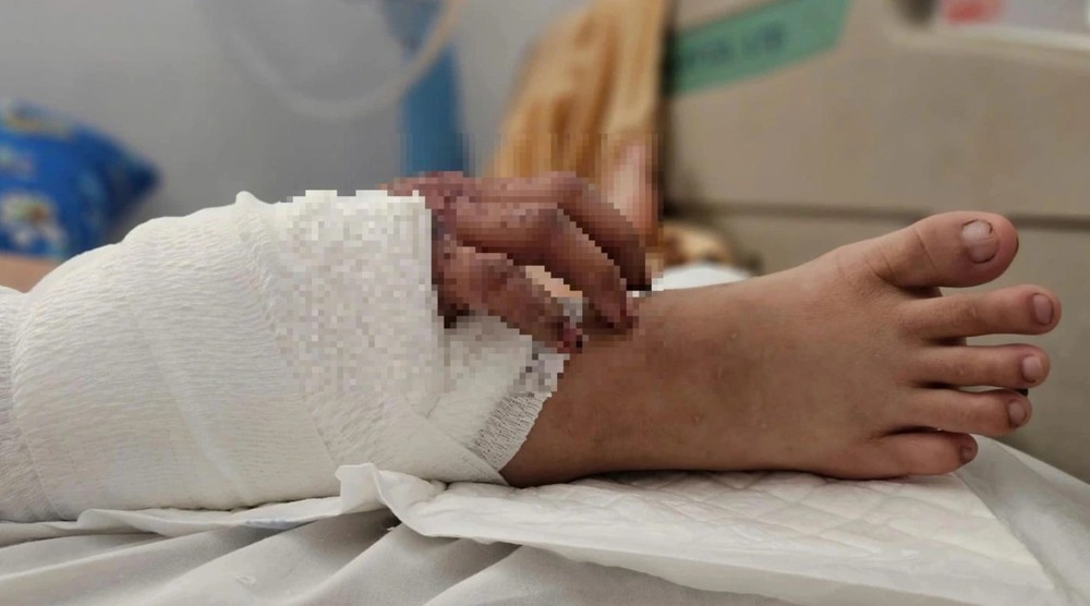 断掌成功移植到小腿上，为孕妇带来保留手部功能的希望。