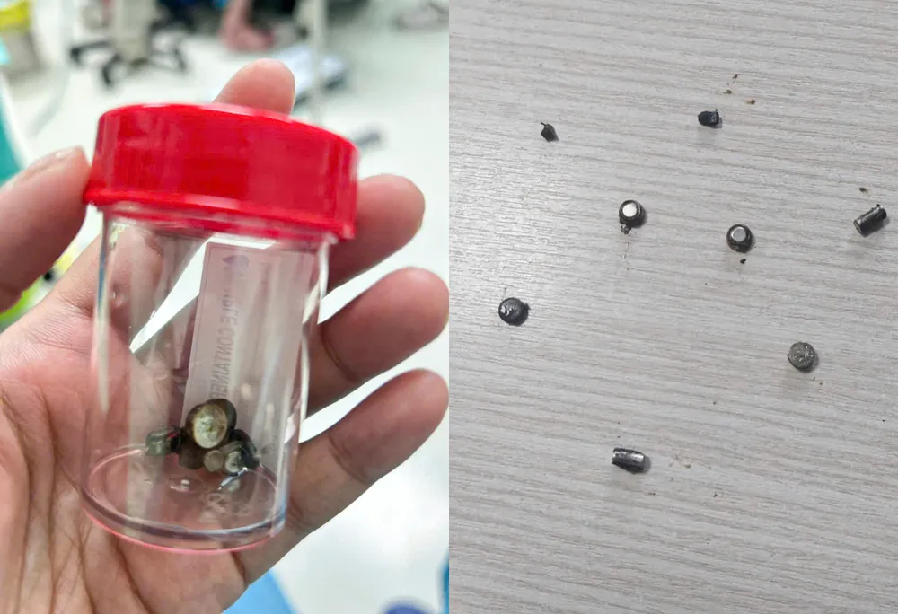 Các dị vật là pin và nam châm được lấy ra từ ruột bé trai 4 tuổi 3685989799980950373.jpg