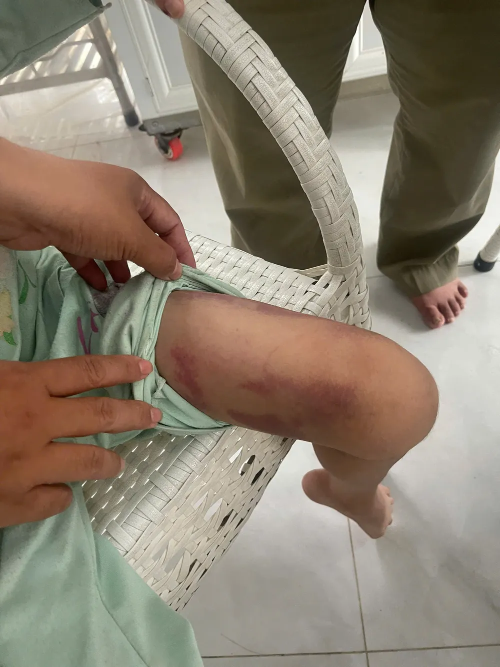 Bé M.T bị đa chấn thương VET THUONG.jpg