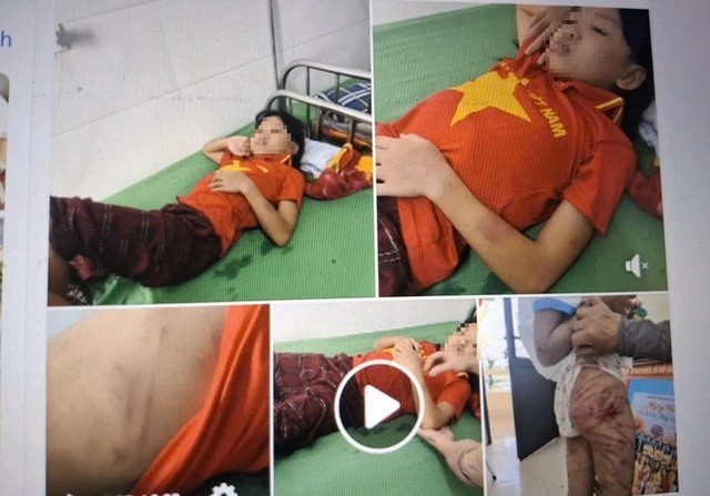 女童身上有多处鞭痕。