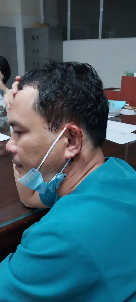 Vùng đầu của điều dưỡng Trương Ngọc Nghĩa bị hành hung chấn thương Vùng đầu của điều dưỡng Trương Ngọc Nghĩa bị hành hung chấn thương