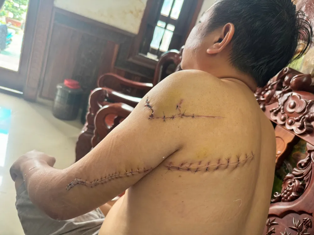 Ông Nguyễn Khắc Tuấn xuất viện về nhà tiếp tục điều trị với nhiều vết thương khắp cơ thể - 3.jpg