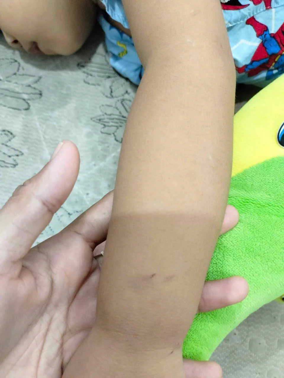 Vết bầm trên tay cháu bé z6599332525665_80774d1abeeacd981e711368bdfec2e4.jpg