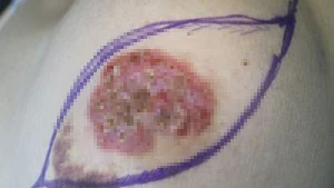 Điều trị thành công cho bệnh nhân ung thư vú Paget hiếm gặp ảnh 1 Điều trị thành công cho bệnh nhân ung thư vú Paget hiếm gặp ảnh 1