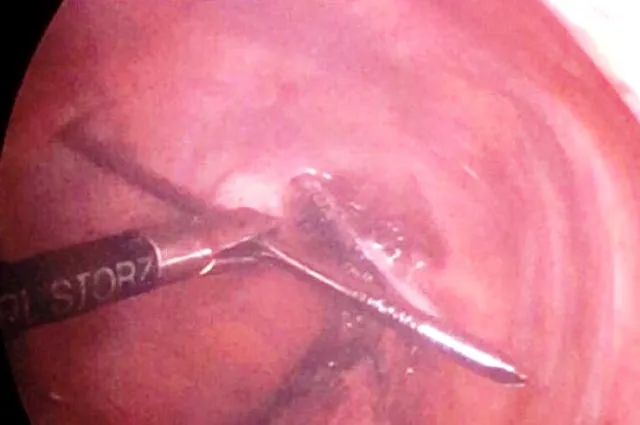 Hy hữu đinh dài 12 cm đâm xuyên đỉnh phổi chui vào tủy sống...vẫn sống ảnh 1 Hy hữu đinh dài 12 cm đâm xuyên đỉnh phổi chui vào tủy sống...vẫn sống ảnh 1