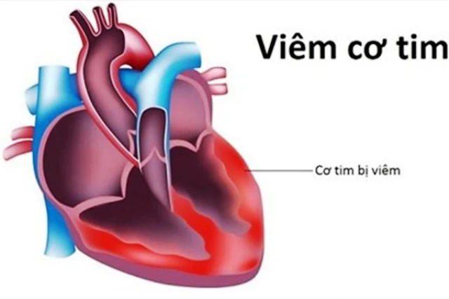 Viêm cơ tim có thể do nhiều loại virus, vi khuẩn gây ra