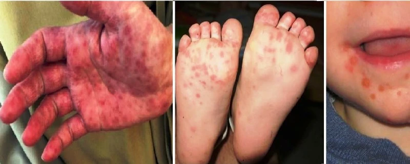 Bộ Y tế yêu cầu khẩn cấp phòng chống dịch bệnh tay chân miệng tăng đột biến ảnh 1 Bộ Y tế yêu cầu khẩn cấp phòng chống dịch bệnh tay chân miệng tăng đột biến ảnh 1