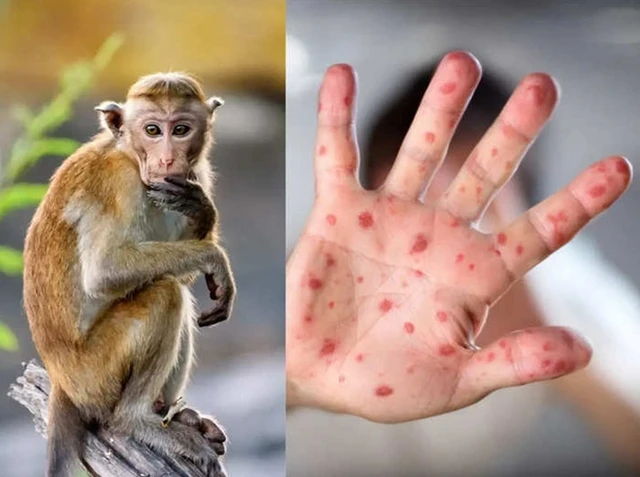 Việt Nam ráo riết chuẩn bị vaccine, thuốc điều trị đậu mùa khỉ ảnh 2 Việt Nam ráo riết chuẩn bị vaccine, thuốc điều trị đậu mùa khỉ ảnh 2