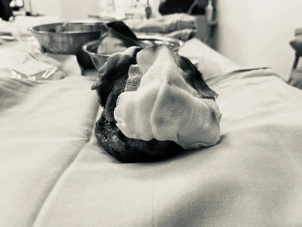 Khối u rất lớn ở mắt bé Đ sau khi được cắt bỏ