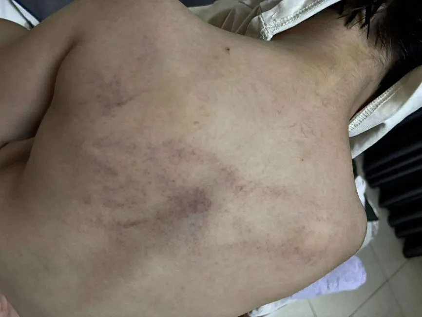 Cháu L. có nhiều vết bầm tím ở lưng sau khi đi học về 333 (2).jpg