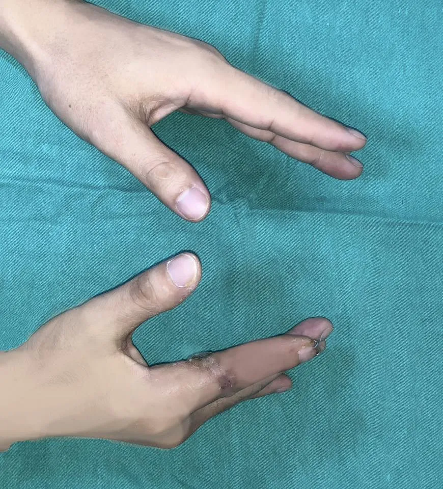 रोगी डी की पुनः जोड़ी गई उंगली हिलने में सक्षम थी। 595249387_1279888300843197_2880628649284439730_n.jpg